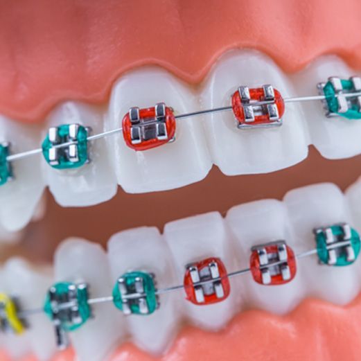 Understanding the Cost of Traditional Braces