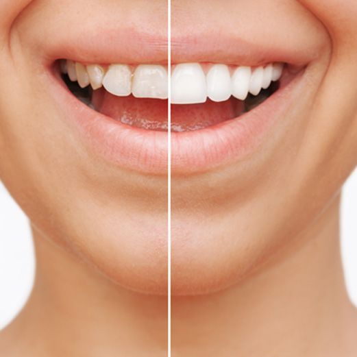Veneers