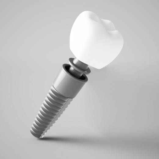 What Are Dental Implants?