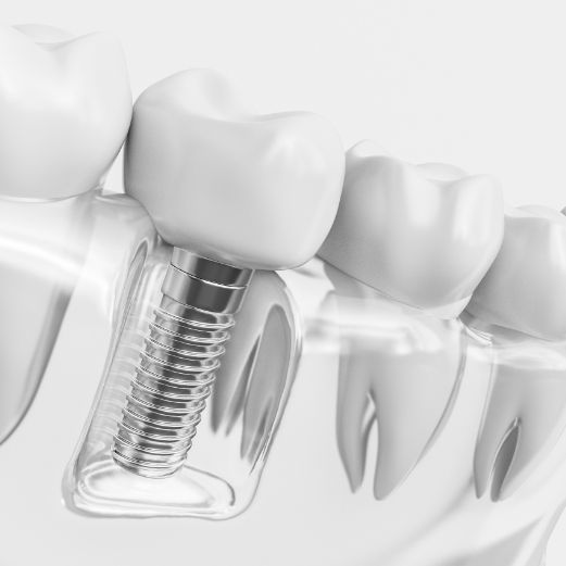Benefits of Dental Implants