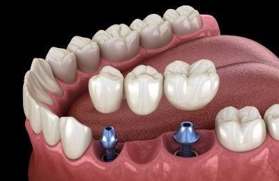 Missing Multiple Teeth
