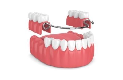 Partial Dentures