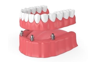 Implant Dentures