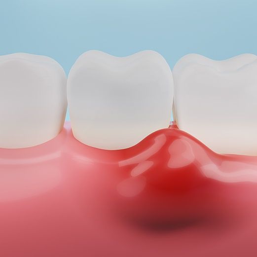 Symptoms of Gum Disease
