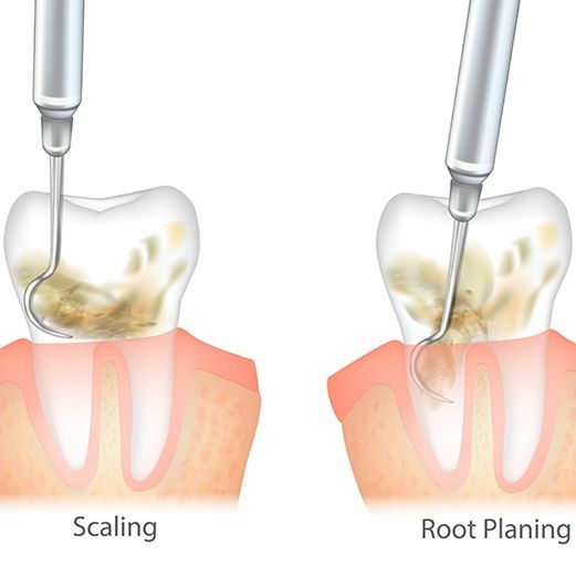 How Do We Treat Gum Disease?
