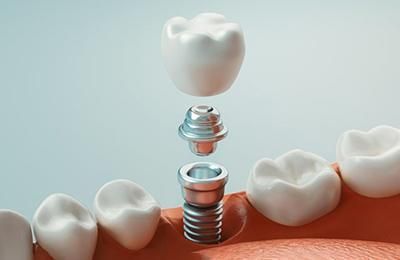 The Parts of Your Dental Implant