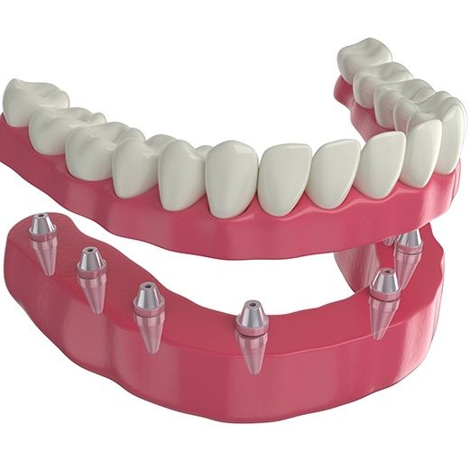 What Are Implant Dentures?