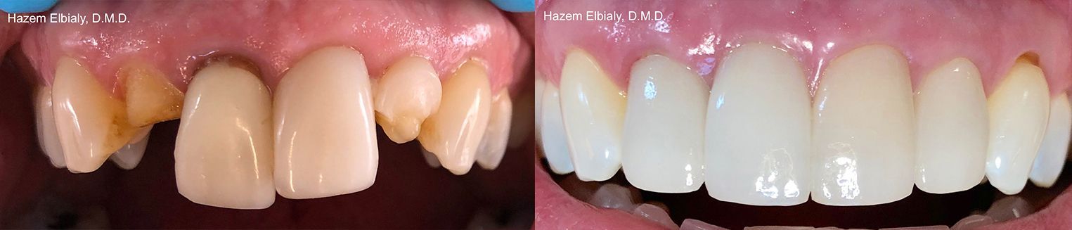 Dental Implants Before & After 1