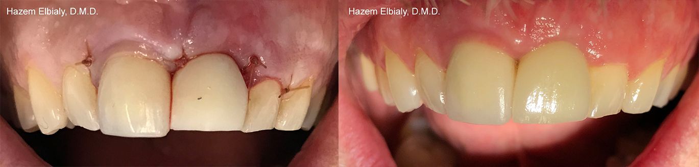 Dental Implants Before & After 2