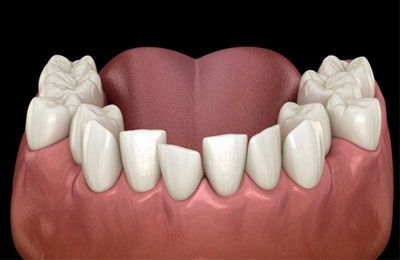 Crowded Teeth