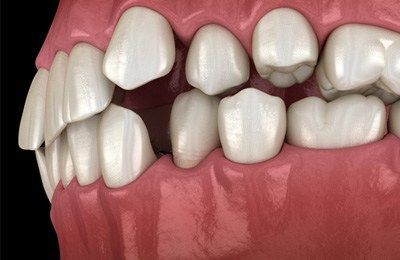 Gaps Between Teeth