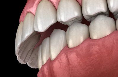 Overbite