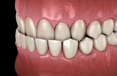 Underbite
