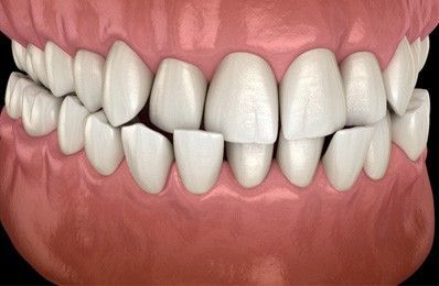 Crossbite