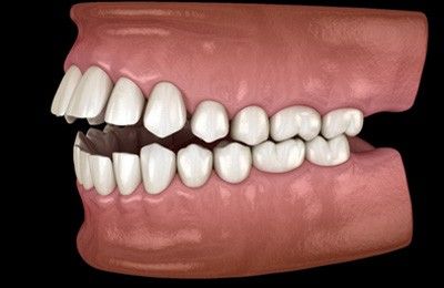Open Bite