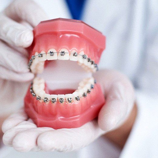 Traditional Braces