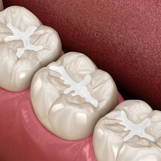 Dental Sealants