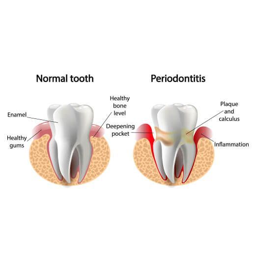 Gum Disease Treatment