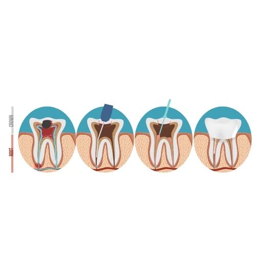 Root Canal Treatment