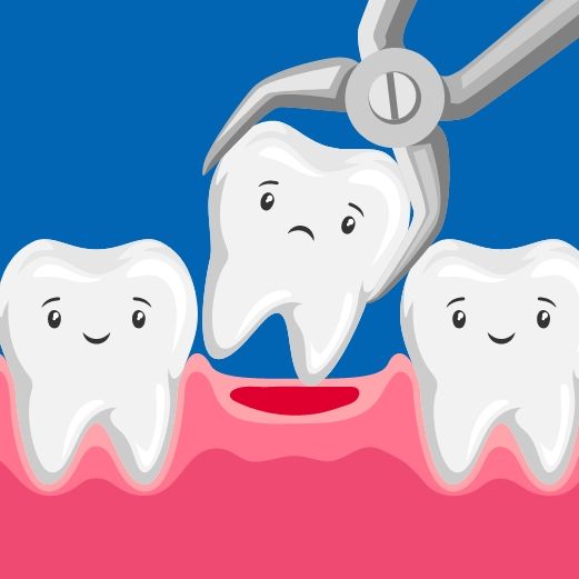 Tooth Extractions