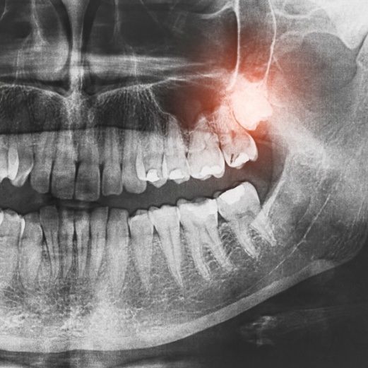 Wisdom Tooth Extractions