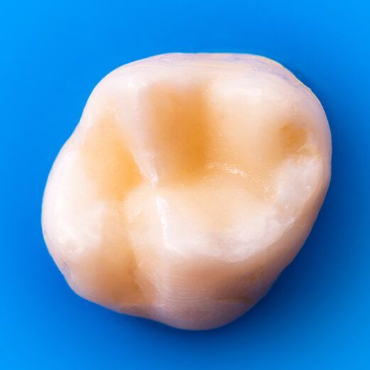 Tooth-Colored Fillings