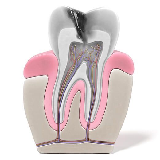 What Is a Root Canal?