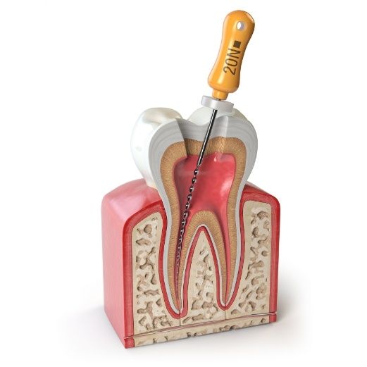 How We Do a Root Canal