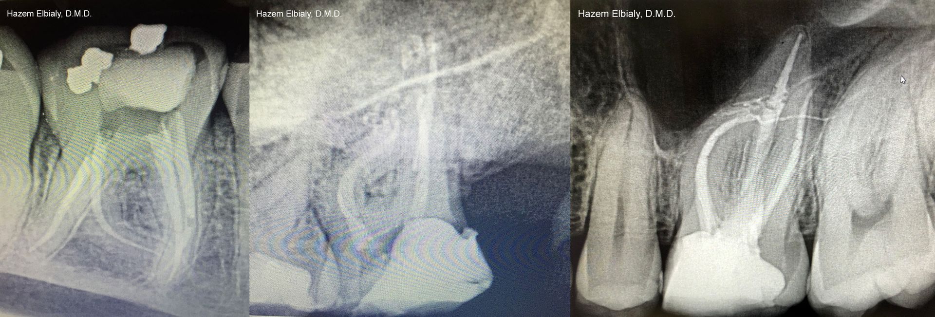 Root Canals 1