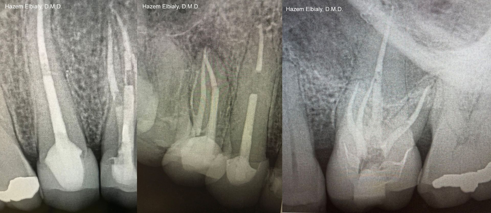 Root Canals 2