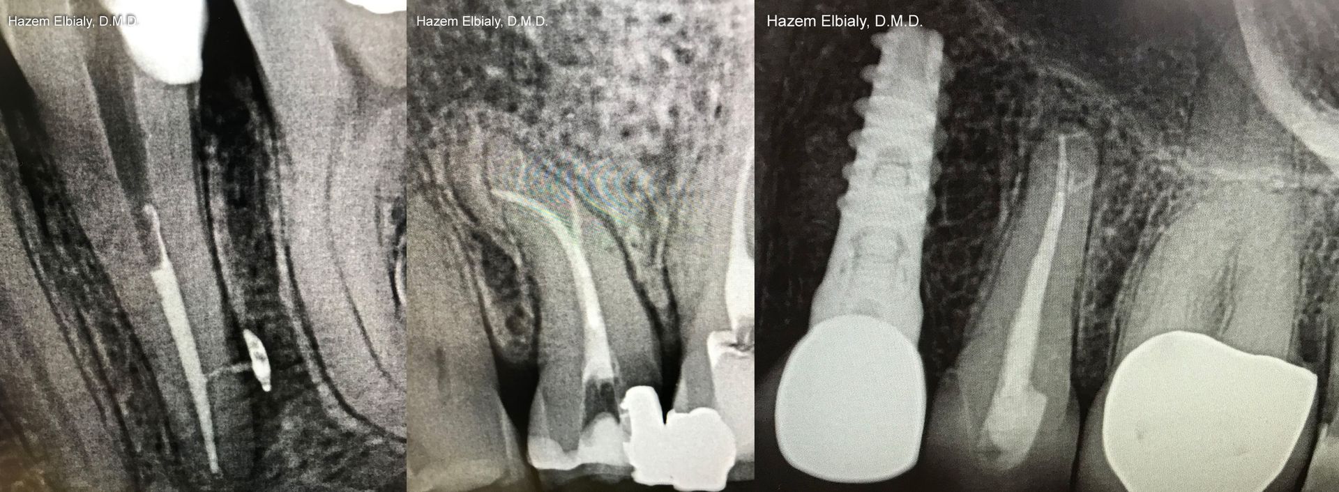 Root Canals 3