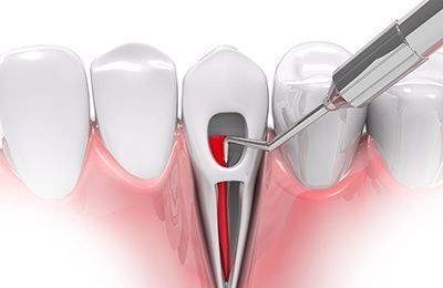 Factors That Can Affect Root Canal Cost