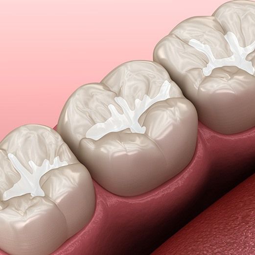 What Are Dental Sealants?