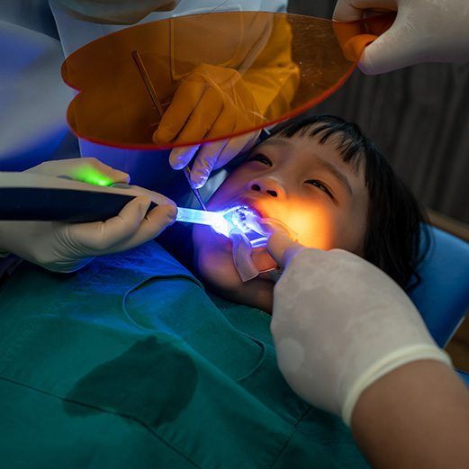 How Are Dental Sealants Placed?