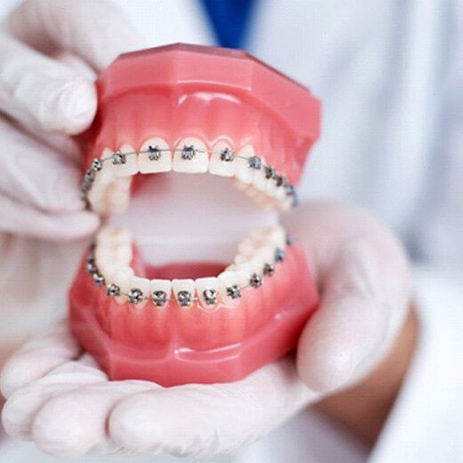 How Do Traditional Braces Work?