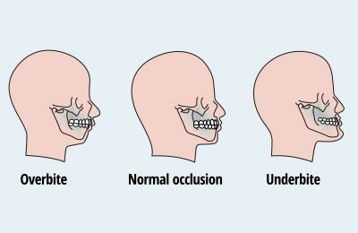 Bite Misalignment