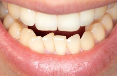 Crowded & Crooked Teeth
