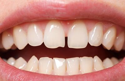 Gapped Teeth