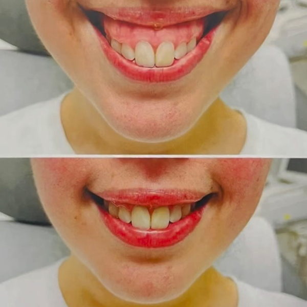 Before-and-after comparison showing the reduction of a gummy smile after cosmetic treatment.