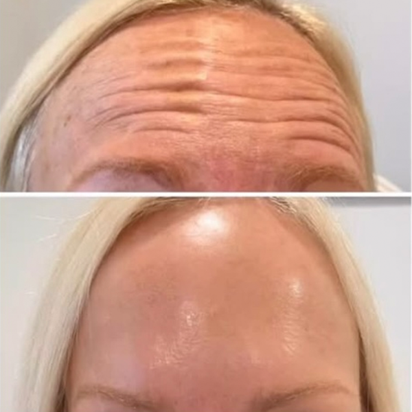 Before-and-after comparison showing the reduction of horizontal forehead wrinkles after a cosmetic treatment.