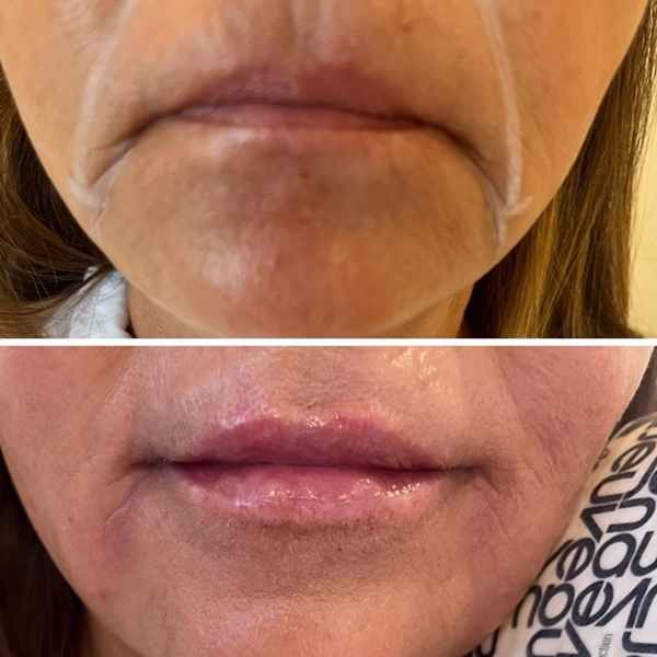 Before and after comparison of the mouth and chin area showing the results of a cosmetic filler treatment.