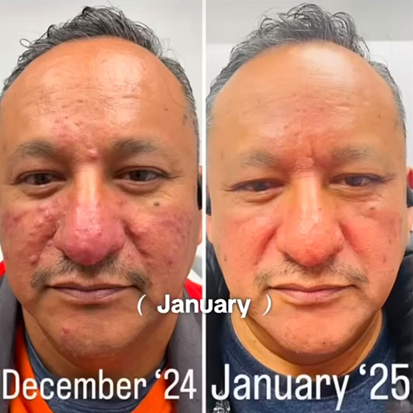 Before-and-after comparison of a person's facial skin condition, showing improvement from December 2024 to January 2025.
