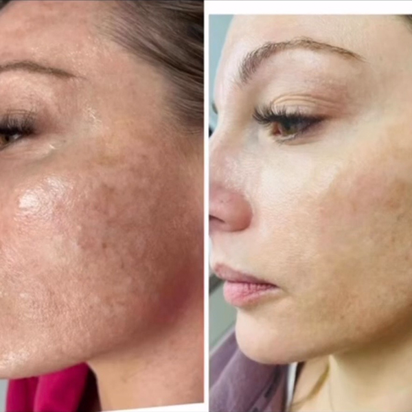 Before and after photos showing reduced facial hyperpigmentation and skin texture improvement.