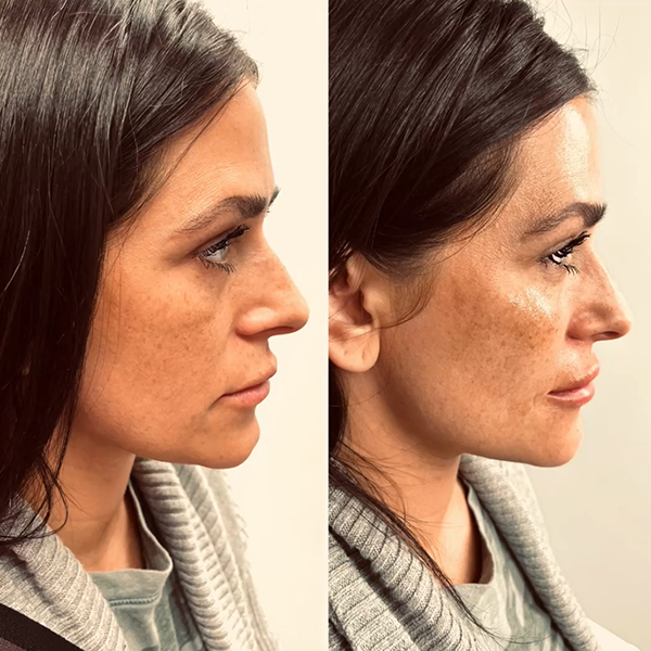 Side-by-side profile portraits showing a before-and-after comparison of a nose after a cosmetic procedure.