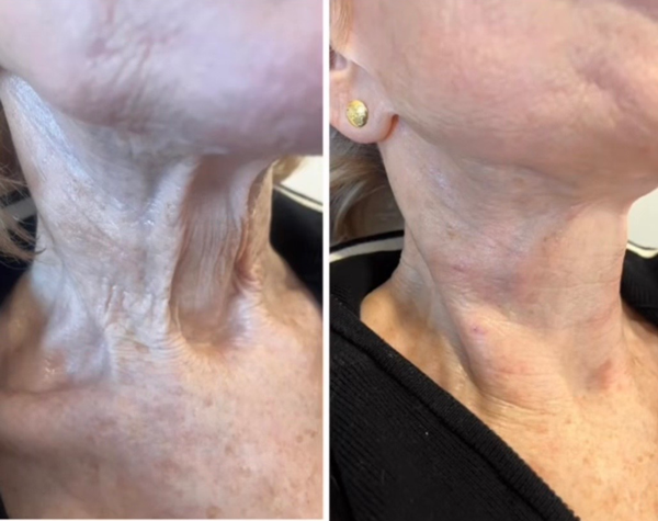 Before and after comparison of a person's neck showing reduced wrinkles and improved skin texture.