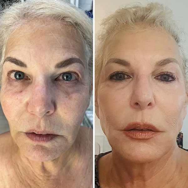 Before and after comparison of a person's face showing reduction in facial lines and improved skin texture.