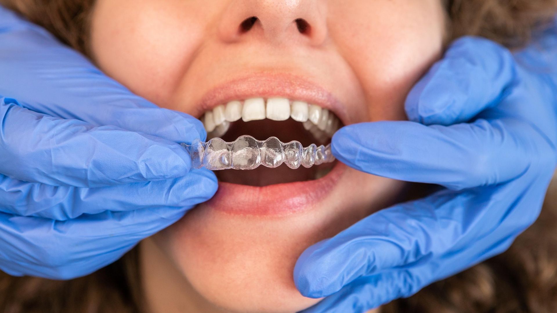 Hands adjusting clear braces on teeth inside a mouth