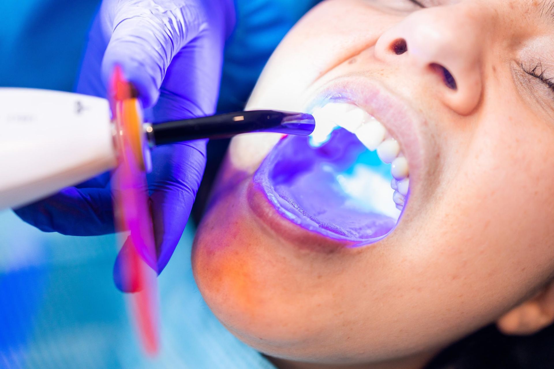 Dental treatment with blue curing light inside a patient’s open mouth