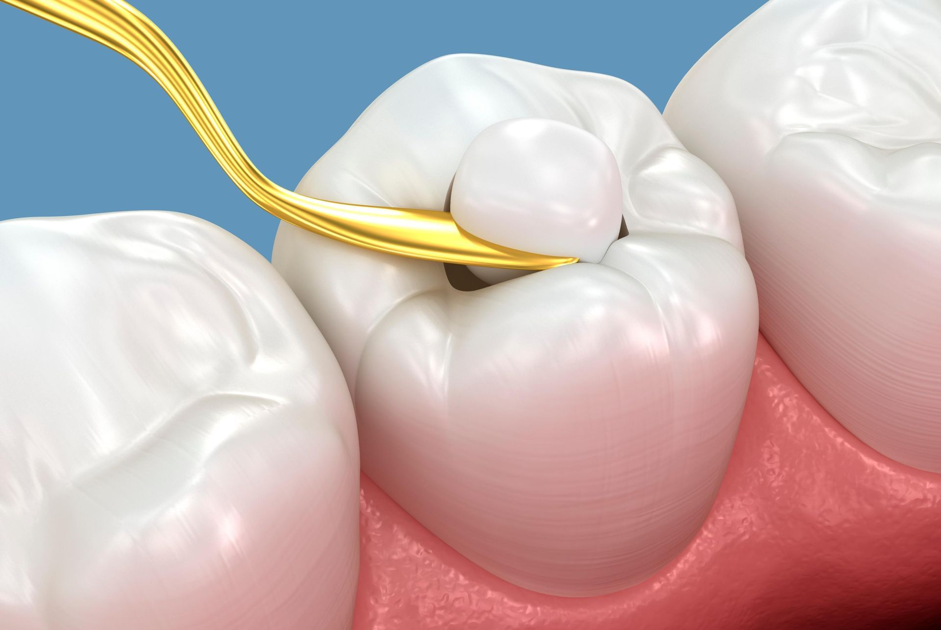 Gold dental scaler cleaning plaque from a white molar near pink gums