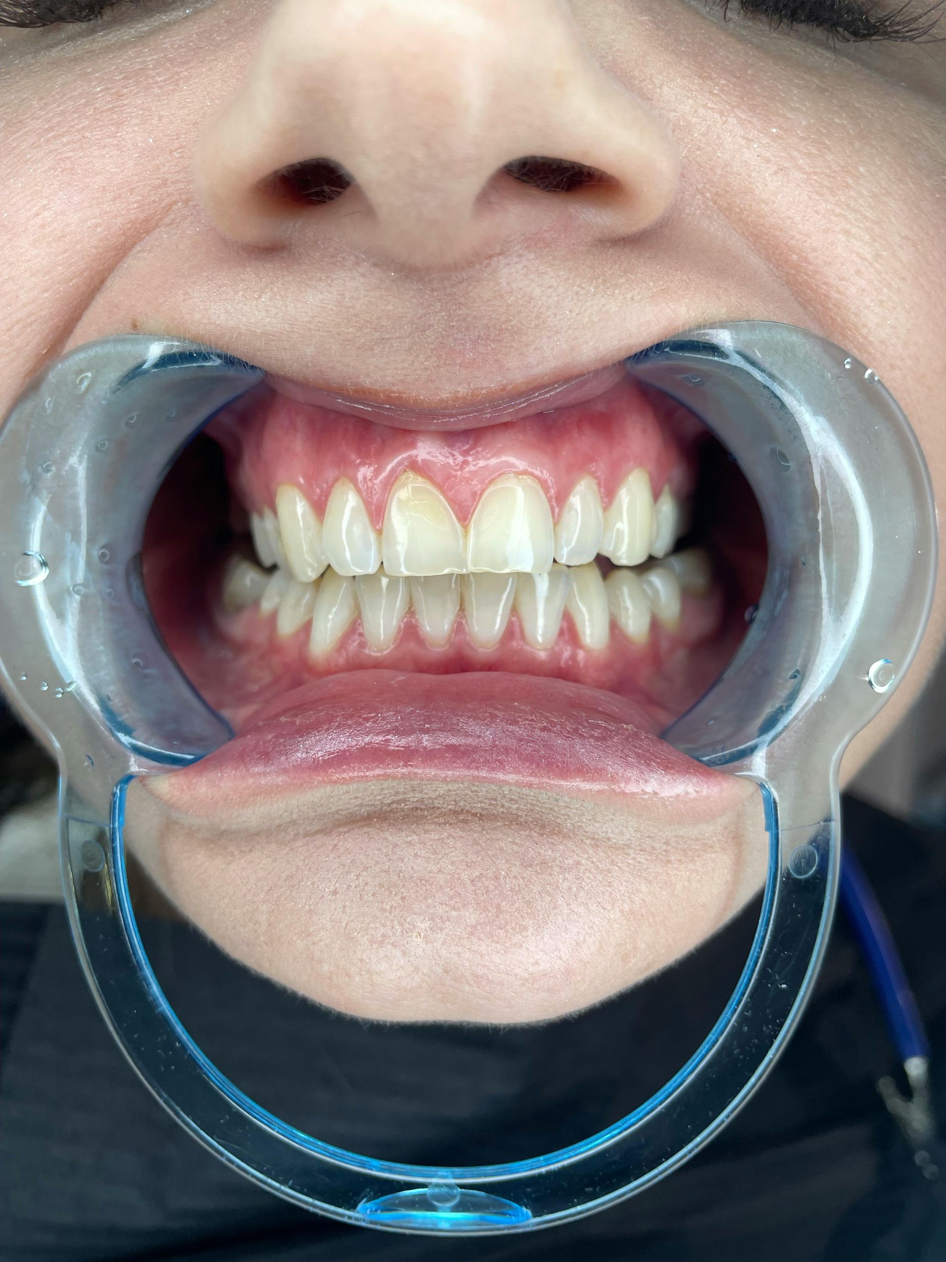 Severe Wear Full Mouth
